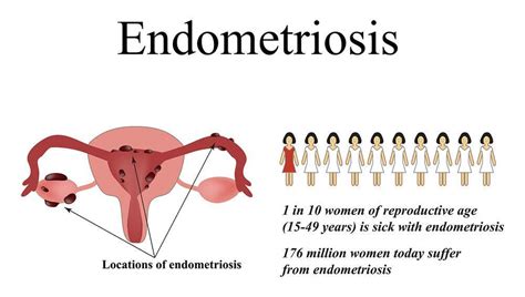 endometriosis is characterized by